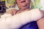 With the broken arm