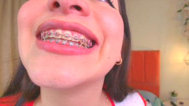 a little more of my braces