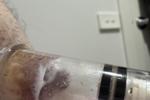 Nipple suckers