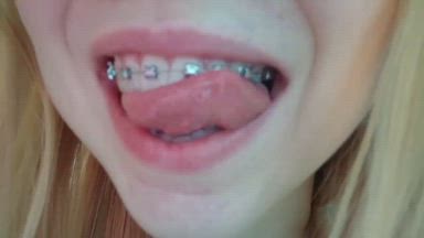 braces