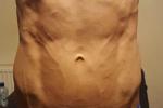 Ab veins