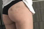 bruise like a peach <3