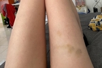 i <3 my bruises
