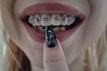 braces