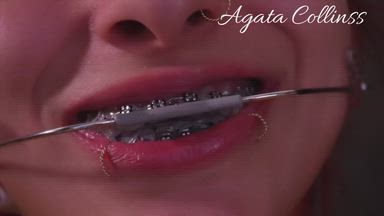 Metallic Attraction: The art of a perfect smile