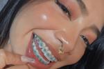 braces