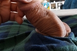 Circumcision Scar Pics