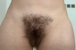 Pussy hair growth progress May'22