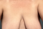 Breast pics