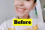 process of my braces