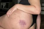 Bumps & Bruises