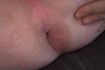 fresh butthole