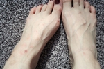 legs and bites of mosquitoes, mazoli