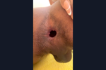 GAPPED ASS