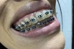black braces