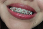 braces