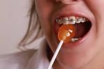 braces