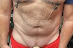 Nipple Clamps