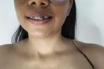 braces♥