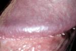 Pearls(pearly papules)