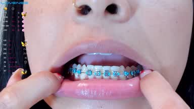 Braces