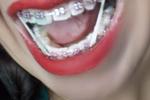 My mouth's brackets