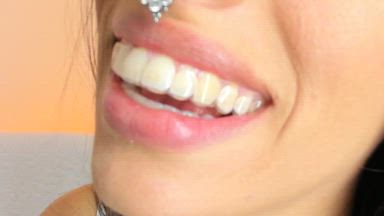wearing retainers