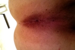 My butthole