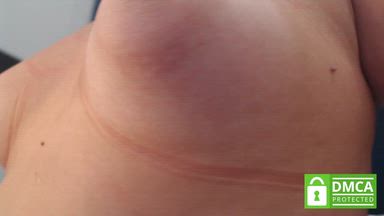 Rope marks on the chest