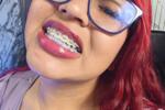 BRACES - VERONICA