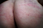 sore ass