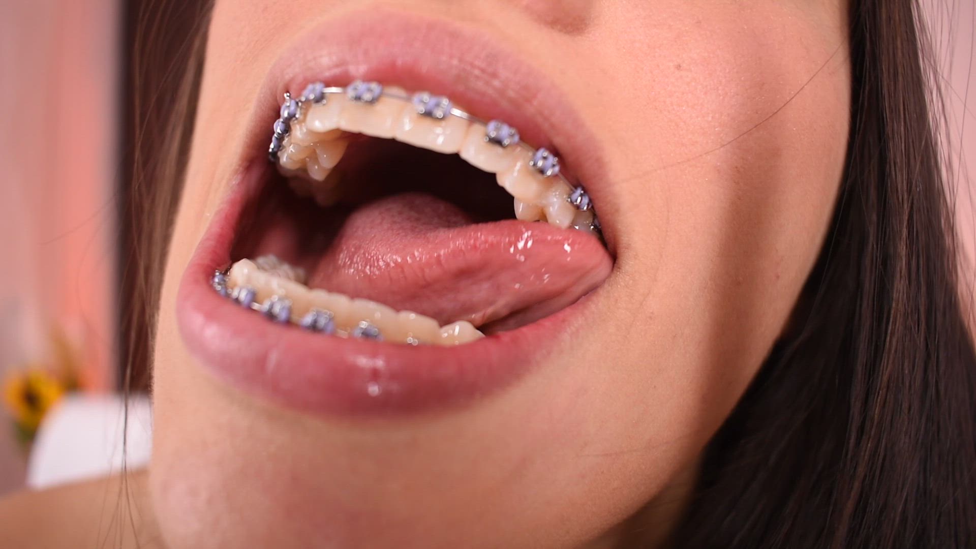 video completo los brackets