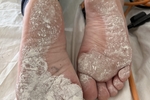 Tyler’s plasterer’s feet
