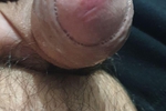 FORESKIN PRECUM