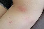 Bite Marks :3