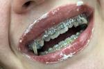 braces and cake