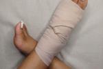 my feet bandaged  🦶🤕