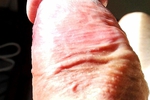penis