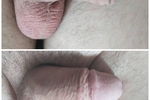 accessdeniedat โ Before and after Circumcision