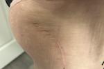 Small scar