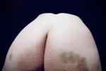 Bruised Ass