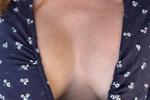 Crowdfunding Replacement Implants