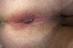 My ass before and after analplay