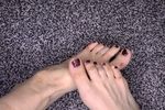 feet with calluses