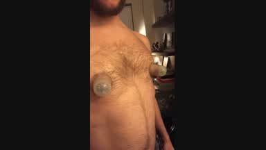 Cupping nipple suckers removed