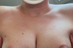 Breast
