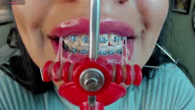 Braces and mask 😁
