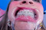 evoleth — Braces , I Love messy