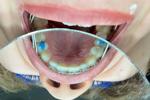 braces and a mirror