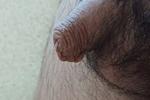 micropenis